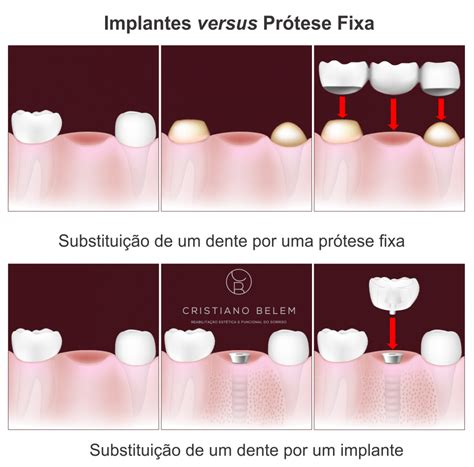 Qual A Diferença Entre Protese Fixa E Implante Dentario Notícias e