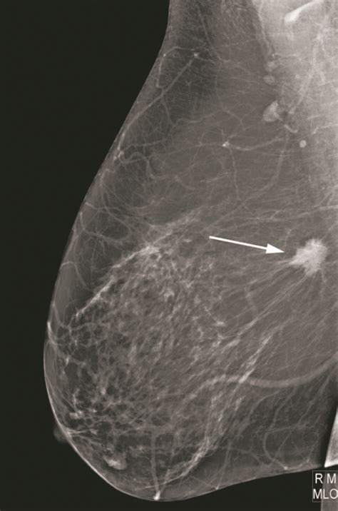 Breast Cancer Basics First In A Series Do I Really Need That Mammogram