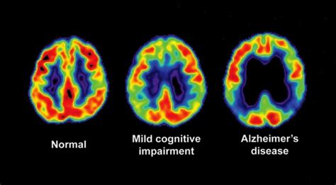 Mild Cognitive Impairment Alzheimers San Diego