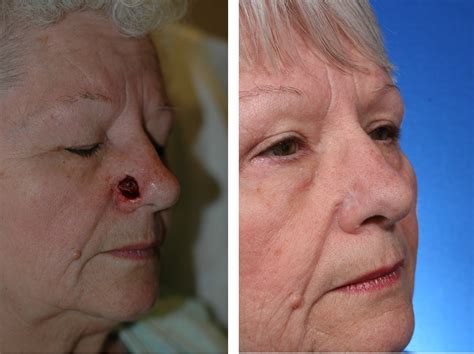 Skin Cancer On Nose Pictures