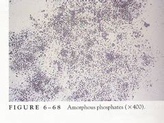 For crystals that are large in the lower two pictures, cylindrical bilirubin crystals have formed in association with droplets of fat amorphous crystals appear as aggregates of finely granular material without any defining shape at. Urinalysis Lecture 6: Microscopic Examination of Urine LMU ...