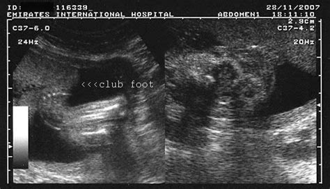 Diagnosing club foot during pregnancy means you. A Gallery of High-Resolution, Ultrasound, Color Doppler ...