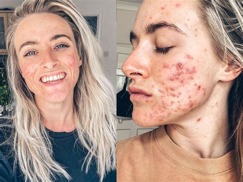 An Acne Positivity Influencer Shares Makeup Free Photos To Inspire Others To Love Their Skin
