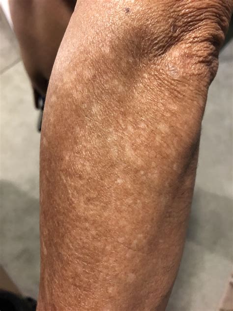 Skin Concerns White Spots On My Fathers Legs And Arms Not Sure What