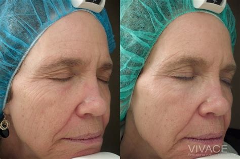 Vivace Rf Microneedling Ageless Remedies Of Roswell