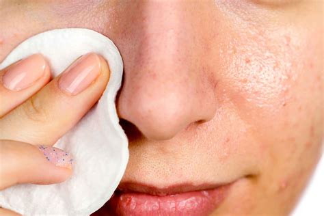 Face Allergy Treatment At Home Doctor Heck