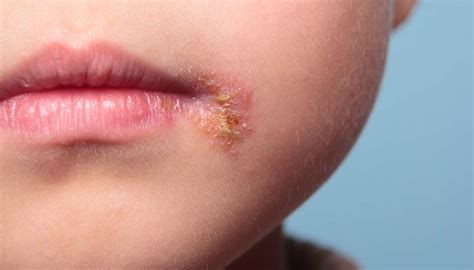 Can Babies Get Cold Sores Causes Treatment And Risks