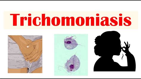 Trichomoniasis Common Sti Causes Symptoms And Complications Cancer Diagnosis Treatment