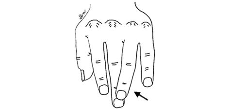 手の中手骨骨折｜一般社団法人 日本骨折治療学会 骨折の解説