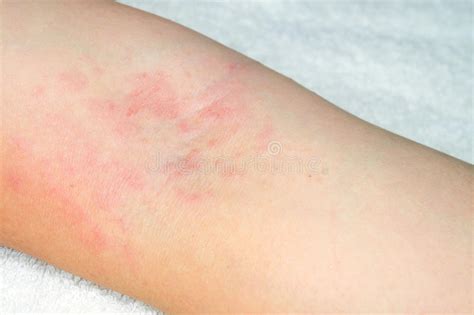 Allergy To Red Rash On The Arms Stock Photo Image Of Allergy