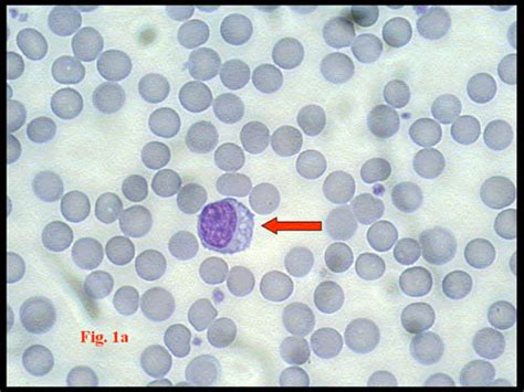 Lymphocyte Vacuolations And Inclusions