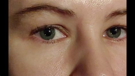 Alcon Acrysof Iq Panoptix Iol Eye Lens Flickering After Cataract