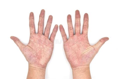 Palmar Erythema Often Called Liver Palms In Both Hands Of Southeast
