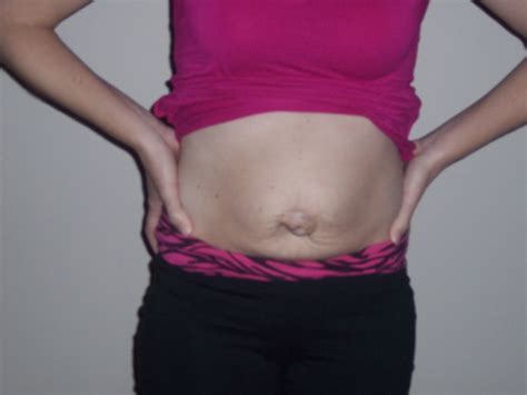 Pregnancy Hernia Above Belly Button Pregnancywalls