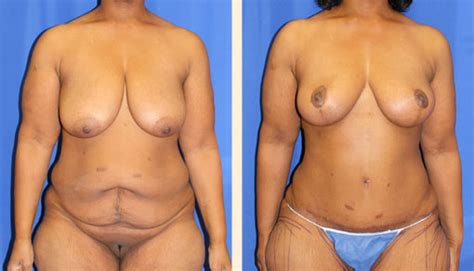 Abdominoplasty Before And After