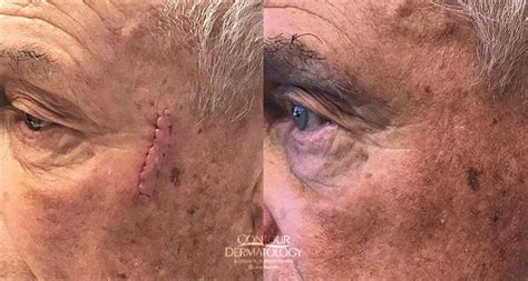 Mohs Surgery Before And After Photos Contour Dermatology