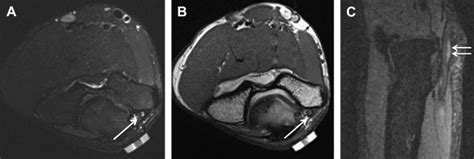 High Resolution Magnetic Resonance Neurography In Upper Extremity