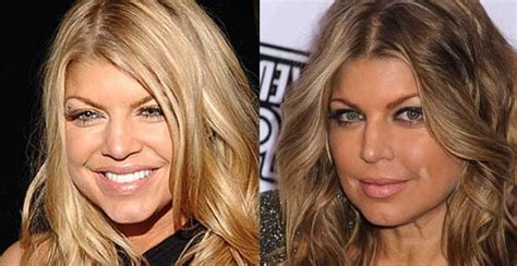 Fergie Before And After Plastic Surgery 6 Celebrity Plastic Surgery