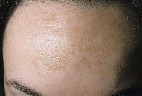 Dehydrated skin lacks water and appears dull or rough. Picture of Melasma (Pregnancy Mask) #2