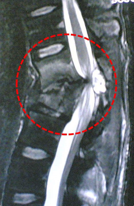 Spinal Cord Injury Clínica Neuros Neurocirujano Valencia