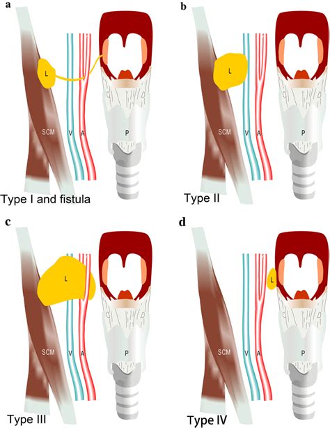 Four Types Of The Second Branchial Cleft Cysts Classified By Bailey And