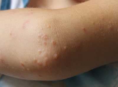 Small bumps on skin that itch. Itchy Bumps on Elbows: 11 Causes and 22 Remedies