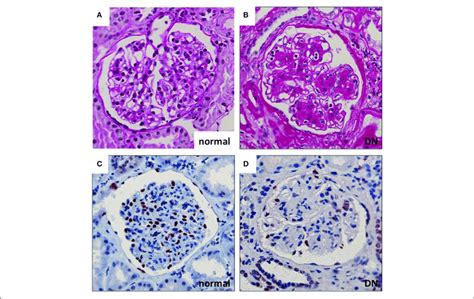 Glomerular Histopathology In Dn A B Diabetic Glomeruli Present Download Scientific Diagram