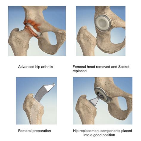 Total Hip Replacement Parts