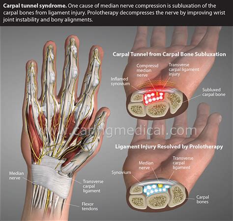 Carpal Tunnel Syndrome Non Surgical Injections And Nerve Release