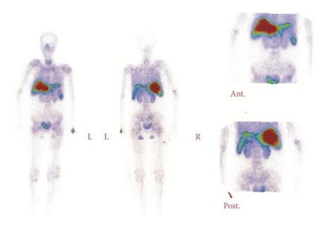 Anterior And Posterior Whole Body Bone Scan Performed Three Hours