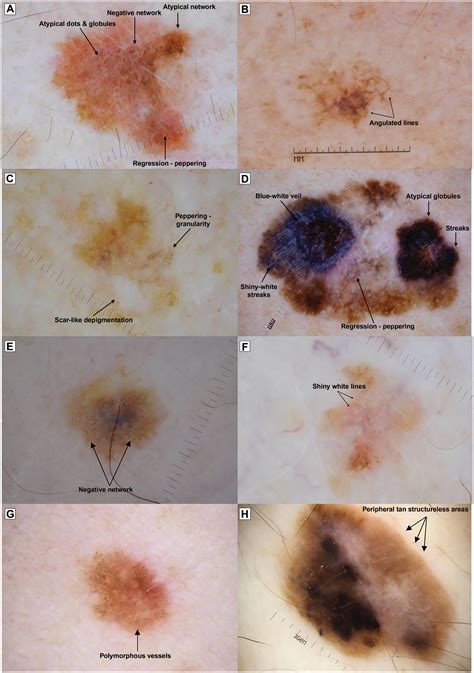 Dermoscopy A Review Of The Structures That Facilitate Melanoma Detection