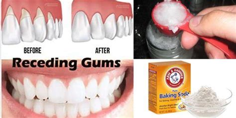 6 Natural Ways To Stop And Heal Receding Gums Before Its Too Late Δόντια