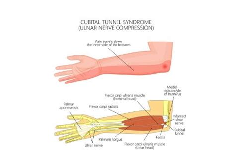 Cubital Tunnel Syndrome Ulnar Nerve Compression South Windsor