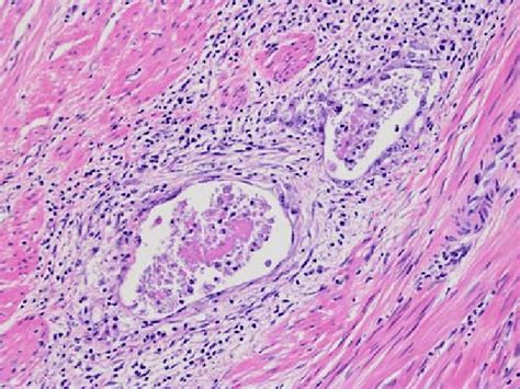 Infiltrative Glands In Foci Showing A Microcystic Elongated And