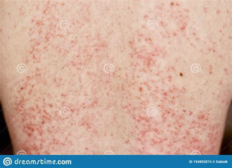 Allergic Rash On Skin Woman With Dermatology Problem On Back Skin