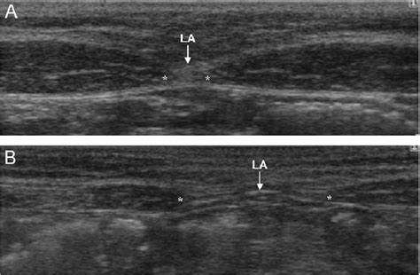 Diastasis recti is a condition where the muscles separate into a right and left side of the abdomen. Ultrasound images showing the inter-recti distance (IRD ...
