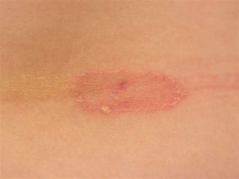15 Best Home Remedies For Ringworm For Instant Relief