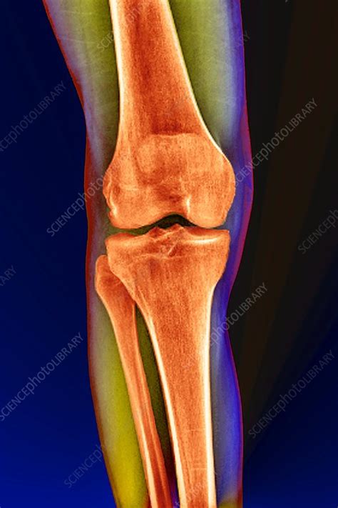 Healthy Knee Joint X Ray Stock Image C0031004 Science Photo Library
