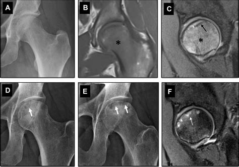 Conventional Radiography Of The Hip Revisited Magnetic Resonance