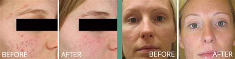 Laser Genesis For Acne Skin By Design Dermatology And Laser Center Pa