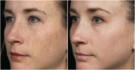 How To Remove Brown Spots On Skin How To Instructions