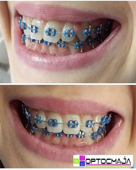 31 Best Colors For Braces Png