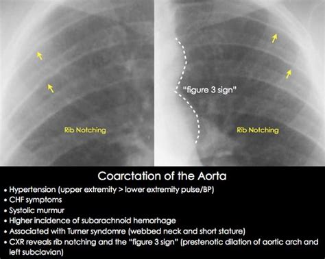 The Radiograph Demonstrates Rib Notching See Diagram Below Which Is