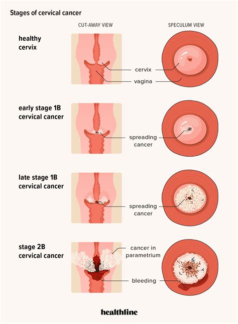 Cervical Cancer Staging How It Guides Treatment And Outlook