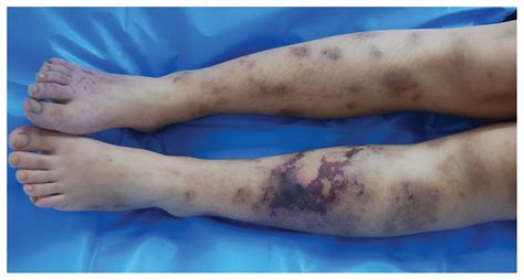 Eosinophilic Granulomatosis With Polyangiitis In A 10 Year Old Girl Cmaj