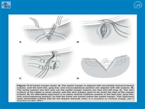 Eyelid Laceration Repair With Defectspptx