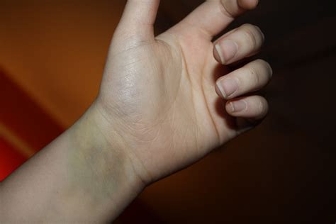 Bruised Wrist Bruised Wrist From Getting Many Ivs Tessapalo0oza