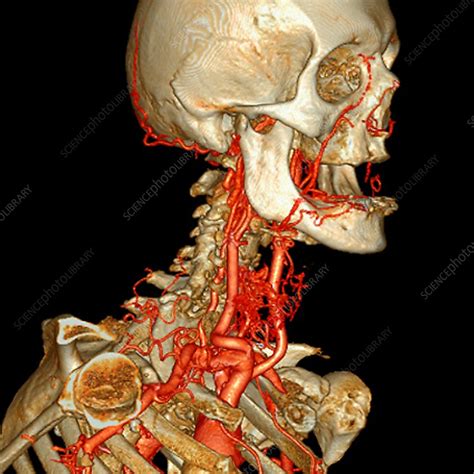 To investigate enhancement of head and neck arteries during carotid computed tomography angiography using a reduced volume contrast regimen and craniocaudal scan acquisition. Neck and head arteries, 3D angio-CT scan - Stock Image ...