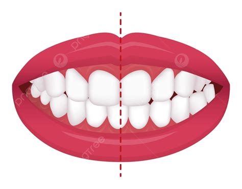 Illustration Of Misaligned Teeth Vector Graphic Depicting Crossbite And