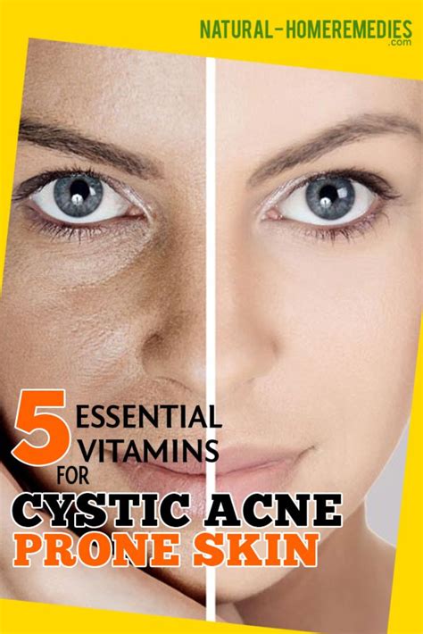 5 Effective Vitamins For Cystic Acne Prone Skin Natural Home Remedies